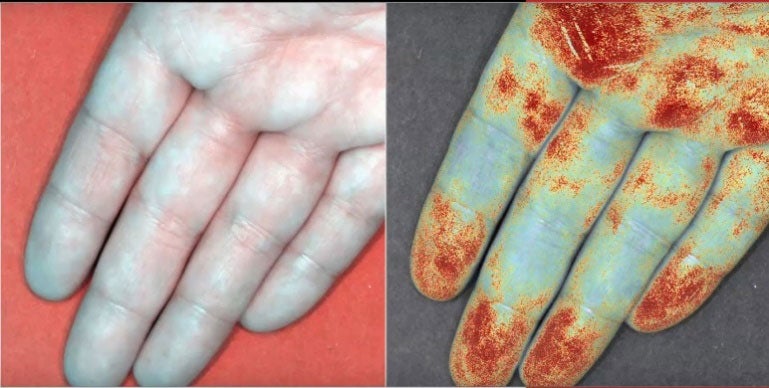 An example of blood perfusion imaging of hand